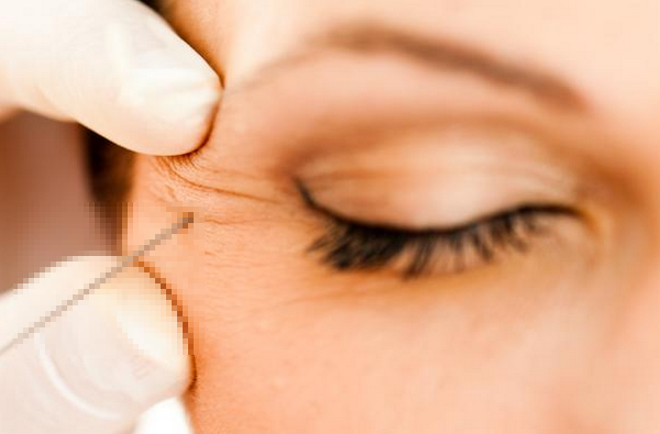 Liệu trình tiêm botox: Số buổi, tần suất, khoảng cách và những lưu ý an toàn