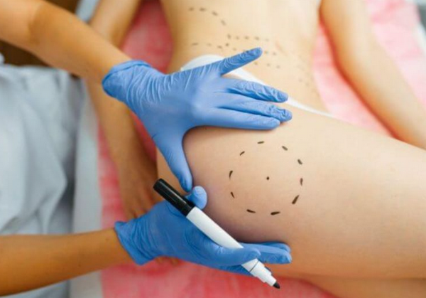 Hỏi đáp: Meso có mấy loại? Loại nào tốt nhất?