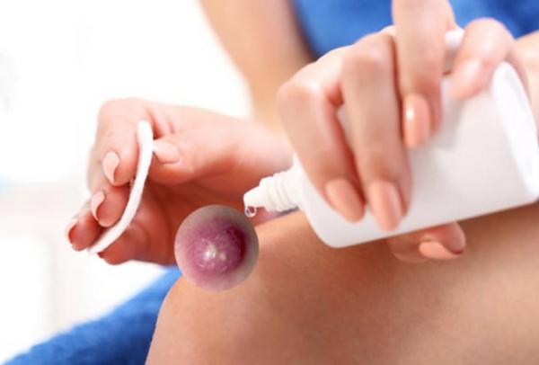 Mụn bị vỡ: Nguyên nhân, nguy cơ và cách xử lý an toàn