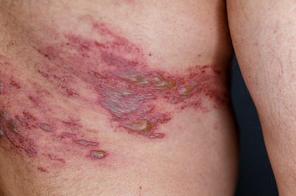 Mụn nước zona bị vỡ và cách chăm sóc tại nhà