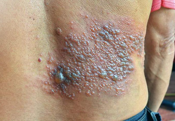 Mụn nước zona bị vỡ và cách chăm sóc tại nhà