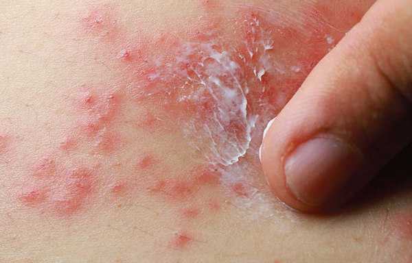 Mụn nước zona bị vỡ và cách chăm sóc tại nhà