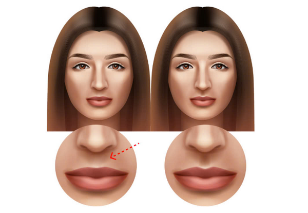 Nếp nhăn nhân trung: Nguyên nhân, ảnh hưởng và cách xoá nhăn