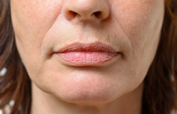 Nếp nhăn tĩnh: Nhận diện, vị trí và cách làm đầy