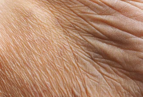 Nếp nhăn tĩnh: Nhận diện, vị trí và cách làm đầy