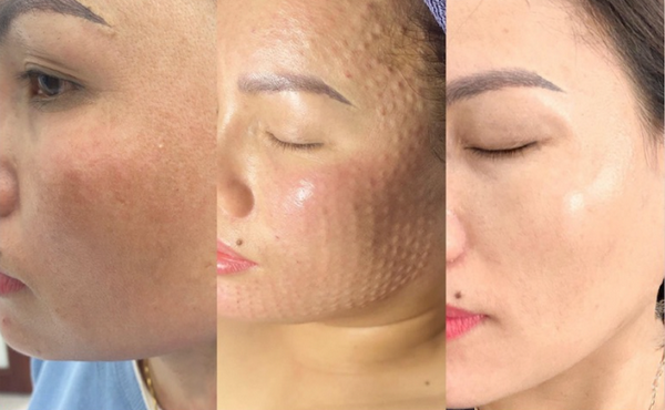 Peel da sau tiêm meso được không? Cần lưu ý những gì?