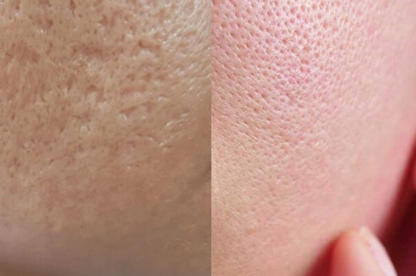 Phân biệt sẹo rỗ đáy nhọn và lỗ chân lông to