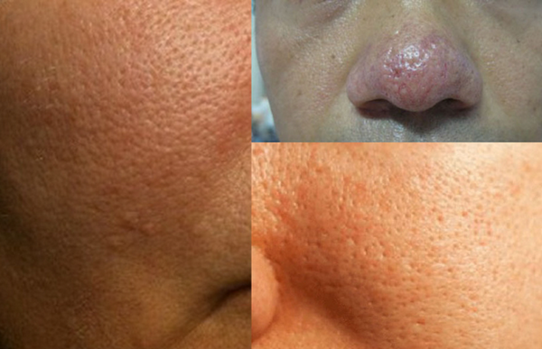 Phân biệt sẹo rỗ đáy nhọn và lỗ chân lông to