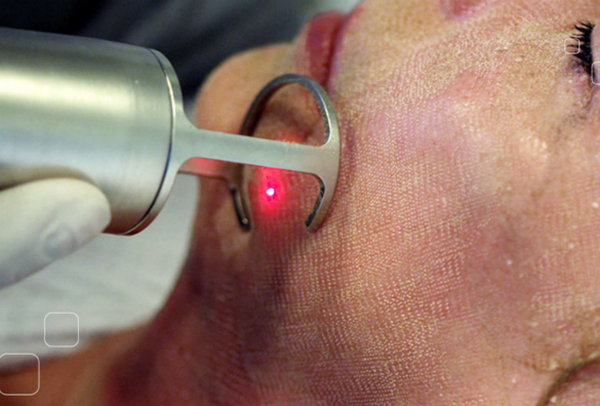 Phân biệt sẹo rỗ đáy nhọn và lỗ chân lông to