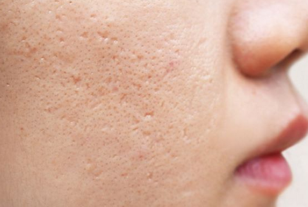 Phân biệt sẹo rỗ đáy nhọn và lỗ chân lông to