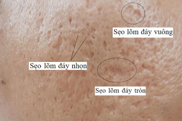 Sẹo đáy kim là gì? Đặc điểm nhận biết và cách điều trị hiệu quả