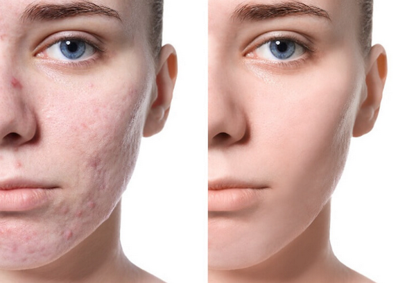 Sẹo đáy kim là gì? Đặc điểm nhận biết và cách điều trị hiệu quả