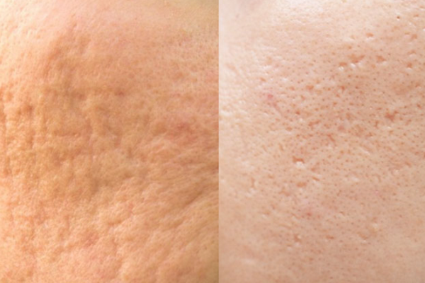 Sẹo nông: Đặc điểm nhận dạng và phương pháp làm đầy