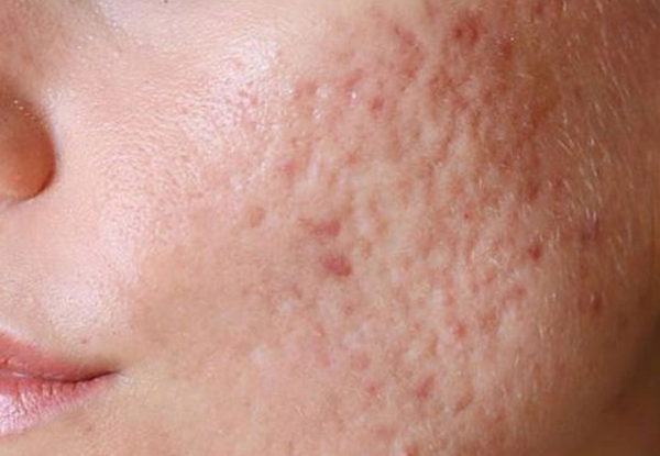 Sẹo nông: Đặc điểm nhận dạng và phương pháp làm đầy