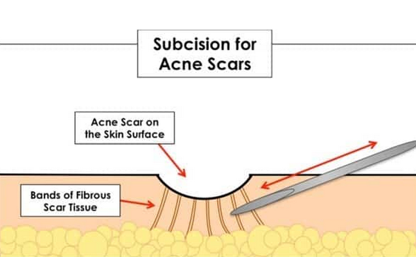 Subcision scar là gì? Cơ chế trong điều trị sẹo rỗ lõm
