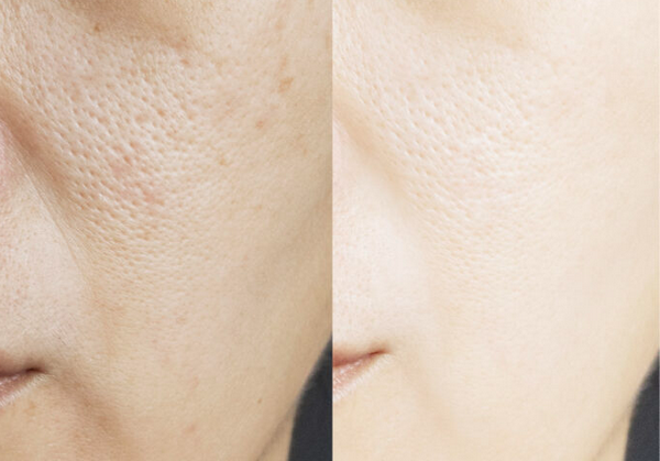 Subcision scar là gì? Cơ chế trong điều trị sẹo rỗ lõm