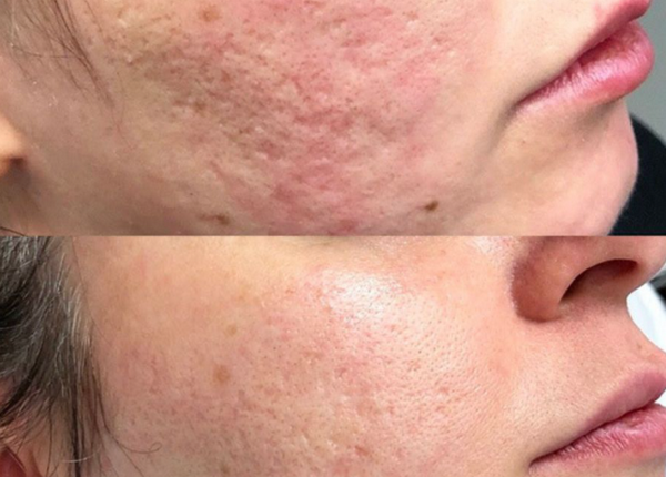 Subcision scar là gì? Cơ chế trong điều trị sẹo rỗ lõm