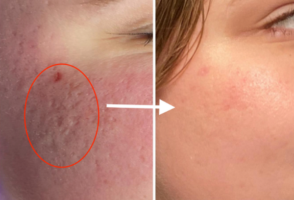 Tăng sinh collagen bằng cách nào tự nhiên và an toàn cho da
