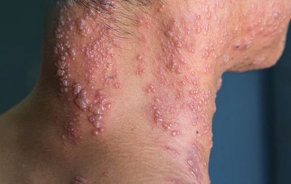 Thuốc trị zona nhanh khỏi, không để lại di chứng