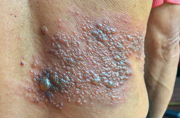 Thuốc trị zona nhanh khỏi, không để lại di chứng