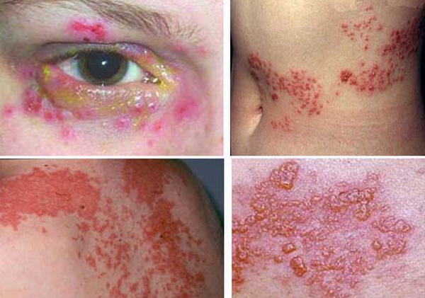 Thuốc trị zona nhanh khỏi, không để lại di chứng