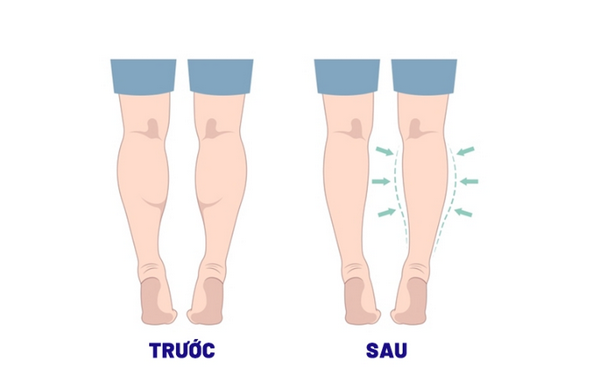 Tiêm botox bắp chân là gì? Có nên tiêm hay không?