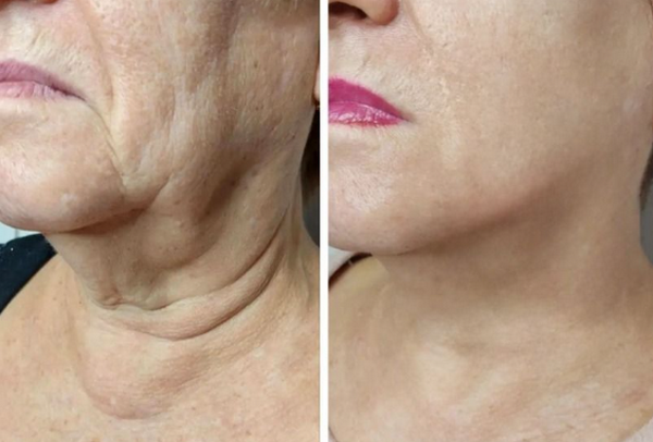 Tiêm meso vùng cổ: Cơ chế, tác dụng và những lưu ý an toàn