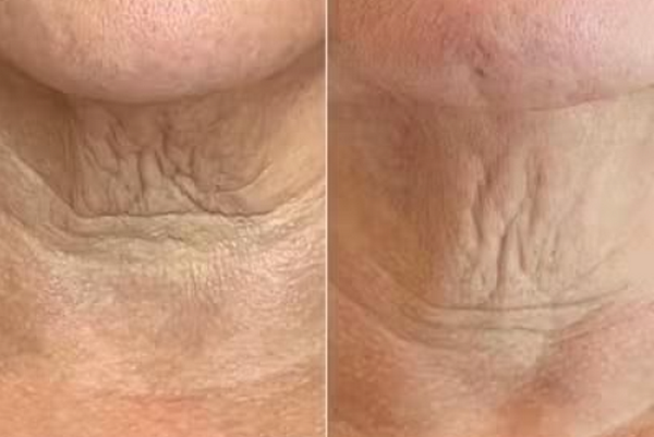 Tiêm meso vùng cổ: Cơ chế, tác dụng và những lưu ý an toàn