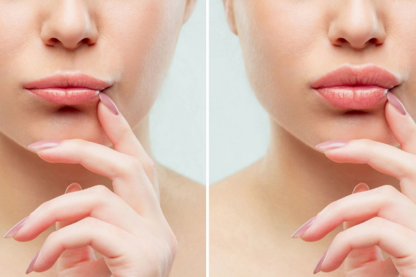 Tiêm môi tều tây: Cơ chế, sản phẩm và quy trình kỹ thuật