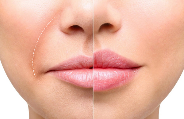 Căng chỉ rãnh cười được bao lâu? Yếu tố ảnh hưởng đến hiệu quả