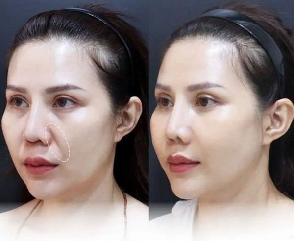 Căng chỉ rãnh cười được bao lâu? Yếu tố ảnh hưởng đến hiệu quả