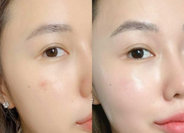 Cấy căng bóng da mặt có tốt không? Phù hợp với ai