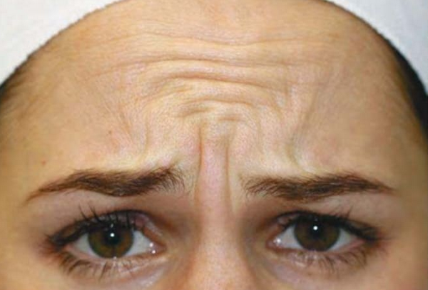 Điều trị nếp nhăn gian mày với botox và những vấn đề liên quan