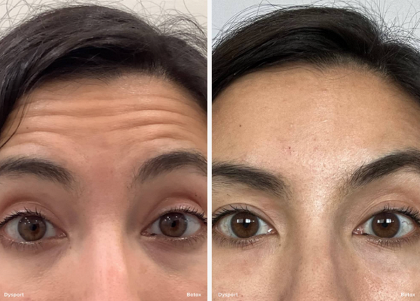 Dysport botox là gì? Dysport khác gì botox? 