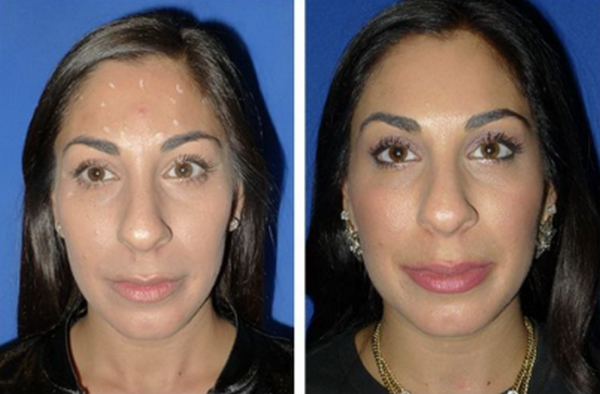 Dysport giữ được bao lâu? Tiêm mấy ngày thì đẹp?