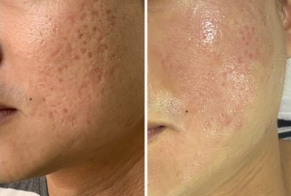 Laser làm đầy sẹo được không? Cơ chế và công nghệ laser điều trị sẹo