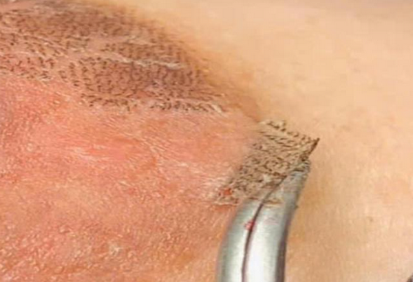 Peel trị thâm nhũ hoa: Cơ chế, chỉ định và lưu ý an toàn