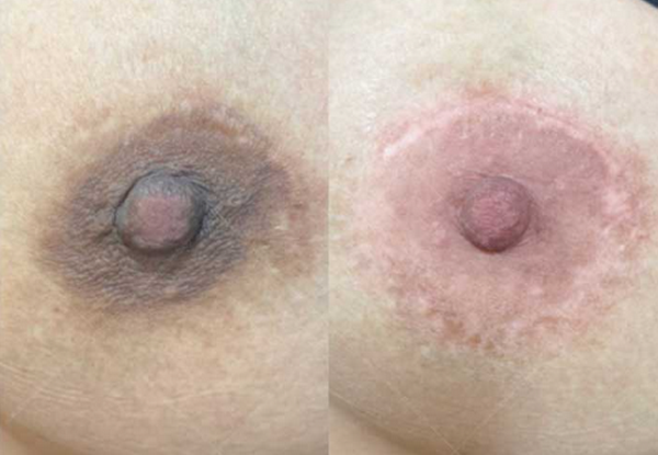 Thâm nhũ hoa do đâu? Có ảnh hưởng gì không?