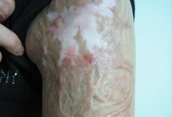 Xoá xăm bằng dung dịch axit có tốt không?