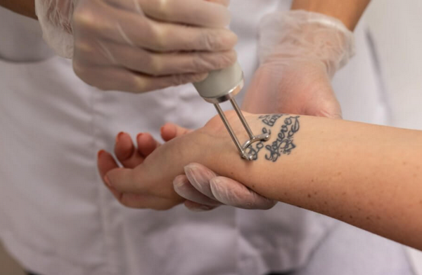 Xóa xăm bao lâu thì bong vảy? Bao lâu da lành hoàn toàn?