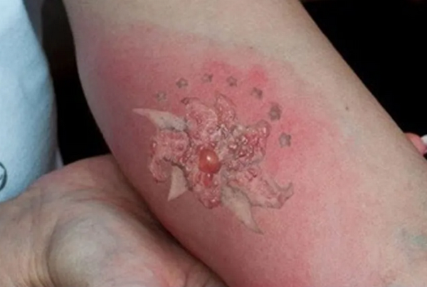 Xoá xăm bị nổi mụn nước: Nguyên nhân và cách xử lý