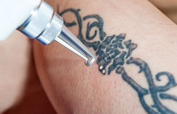 Xoá xăm bị nổi mụn nước: Nguyên nhân và cách xử lý