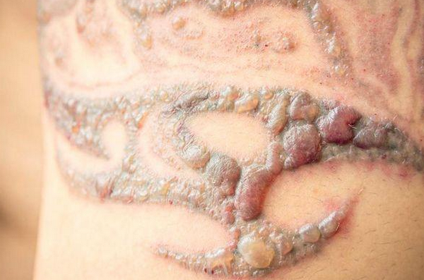 Xoá xăm bị nổi mụn nước: Nguyên nhân và cách xử lý