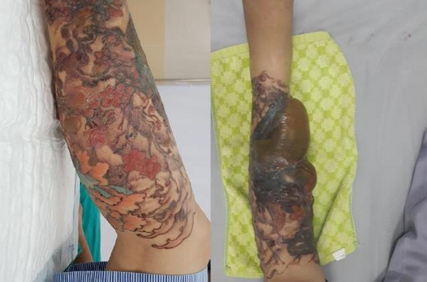 Xoá xăm bị rộp nước có sao không? Nguyên nhân và cách xử lý an toàn