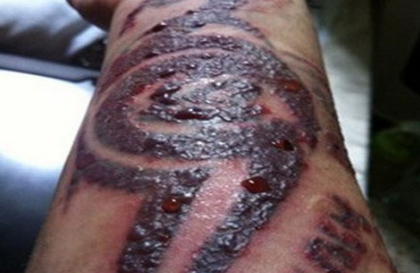 Xoá xăm bị rộp nước có sao không? Nguyên nhân và cách xử lý an toàn