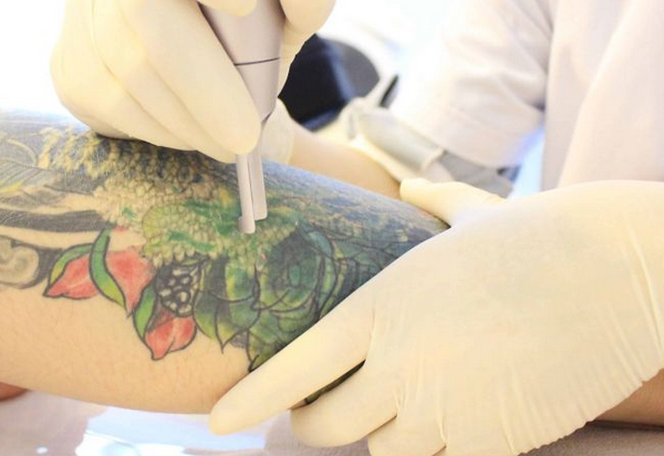 Xoá xăm có để lại sẹo không? Phương pháp xoá xăm không để lại sẹo 