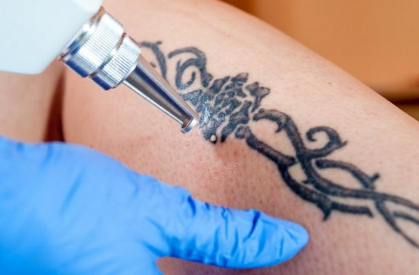 Xóa xăm không sẹo bằng công nghệ laser hiện đại tại Dr.thaiha