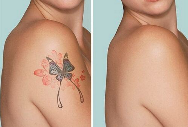 Xoá xăm không sẹo bằng công nghệ laser hiện đại tại Dr.thaiha