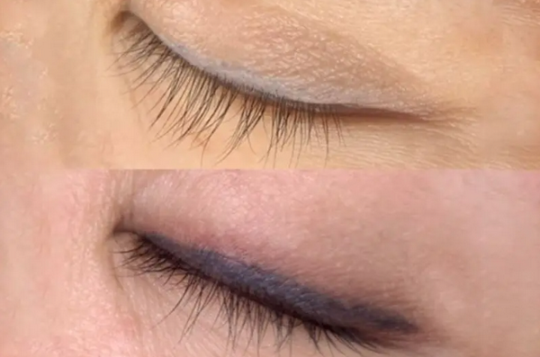 Xoá xăm mí mắt có đau không? Làm bao nhiêu lần hiệu quả