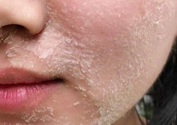 Da khô có nên peel không? Cần lưu ý những gì?